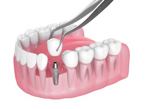 3D dental model showing implant placement in edentulous ridge, with forceps positioning crown abutment
